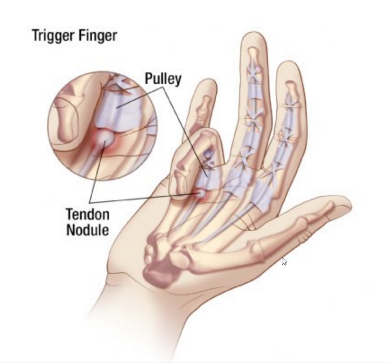 Springvinger Duim Springvinger – Dienst orthopedie en traumatologie